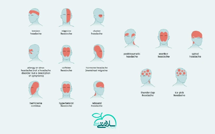 انواع میگرن و روش های درمانی آنها